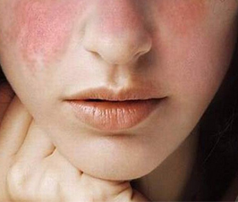 Lupus, una enfermedad controlada