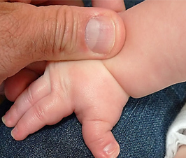 Día Internacional del Síndrome de Rubinstein-Taybi